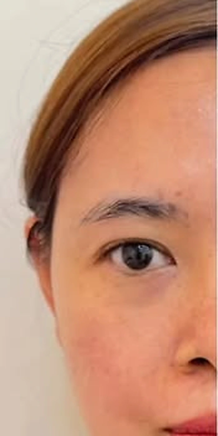 Pigmentation & Skin Tone — after treatment at Savoy Clinic