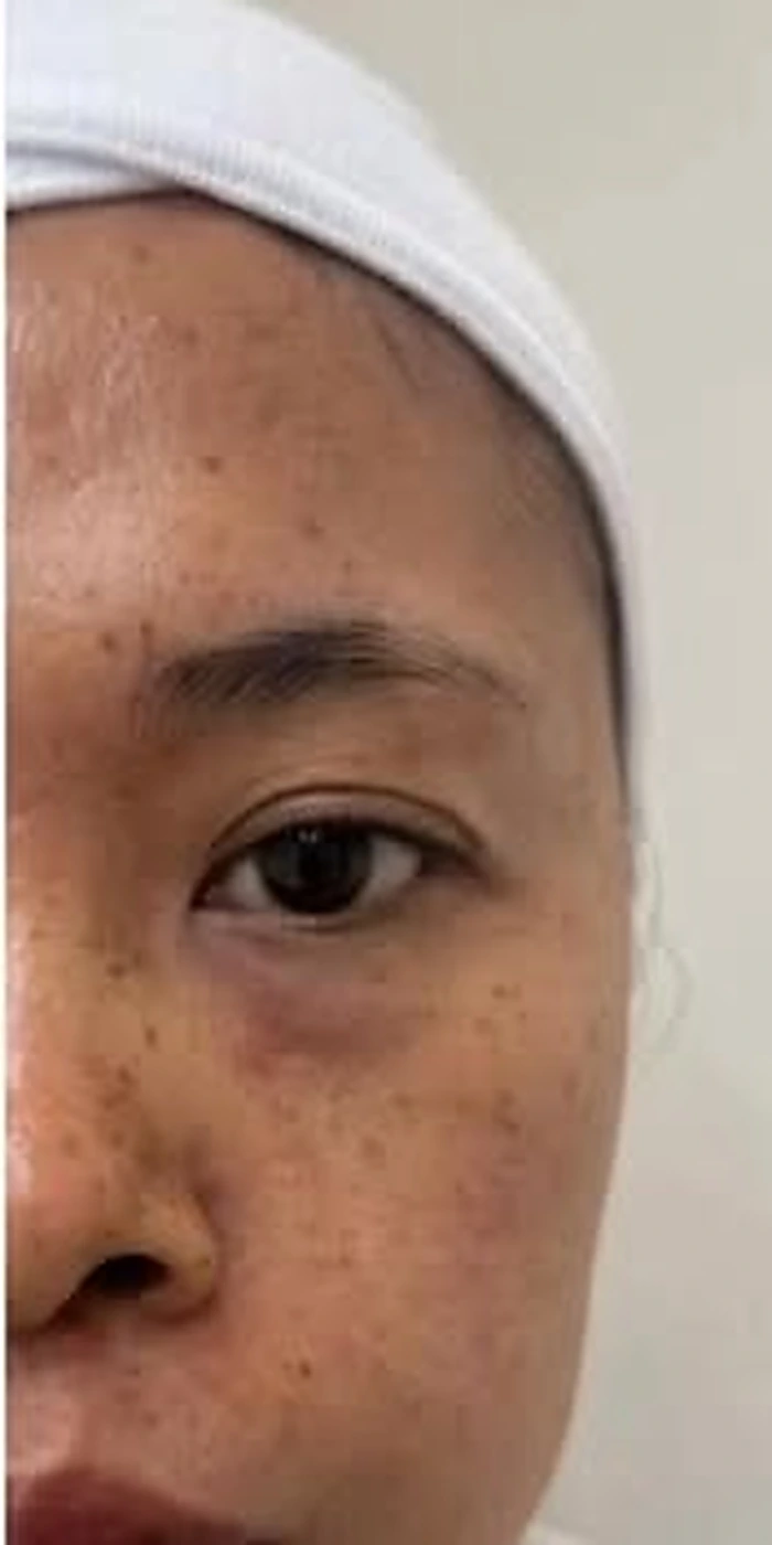 Pigmentation & Skin Tone — before treatment at Savoy Clinic